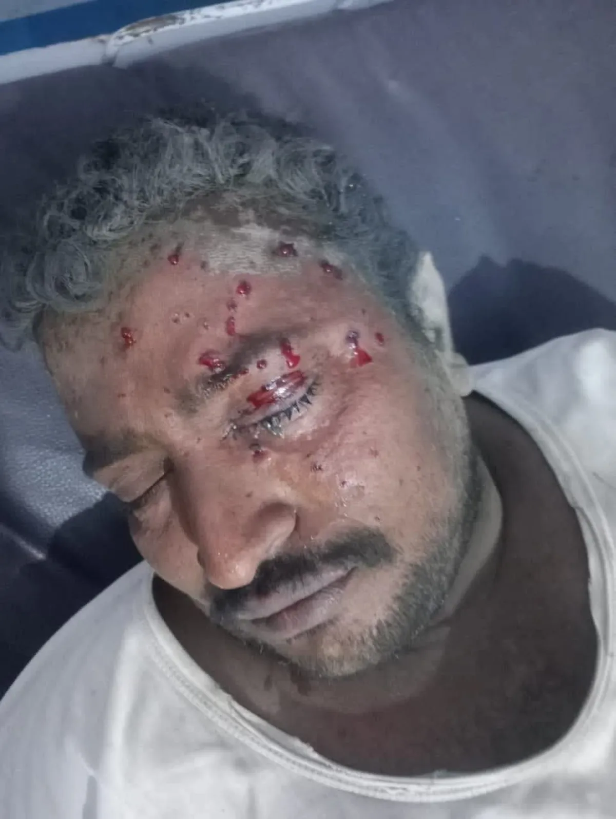 الحديدة.. إصابة مدني بانفجار لغم من مخلفات الحوثيين في حيس